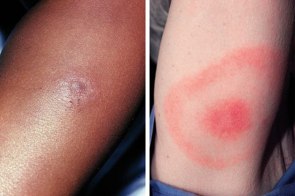 Lyme Disease: Early Treatment vs. Chronic Complications